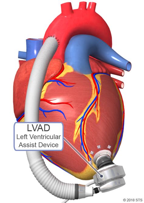 lv device|parts of an lvad.